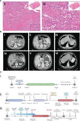 Case report: Fatal overwhelming post-splenectomy infection in a patient with metastatic angiosarcoma treated with immunotherapy